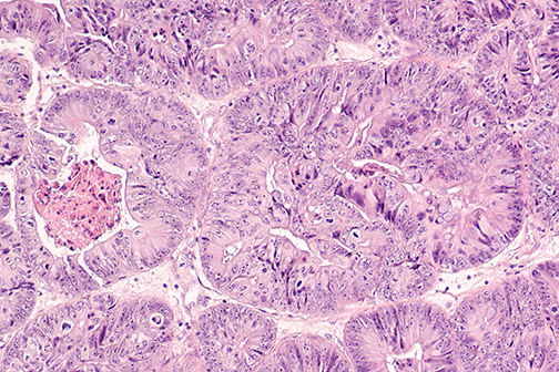 endometrial cancer cells